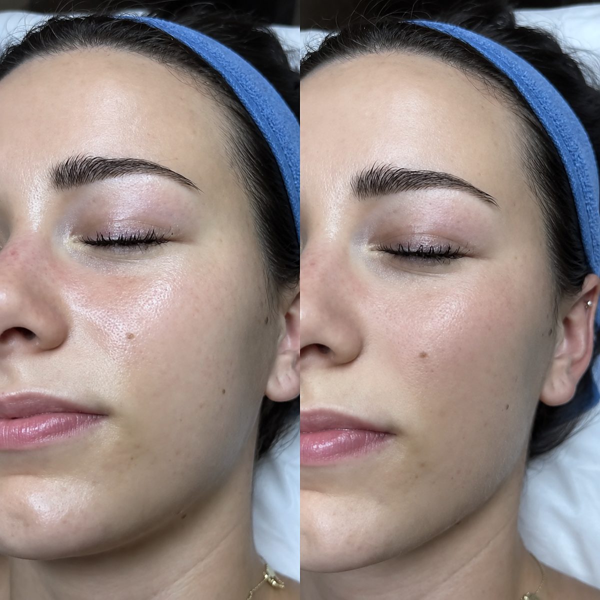 Online-Kurs Dermaplaning
