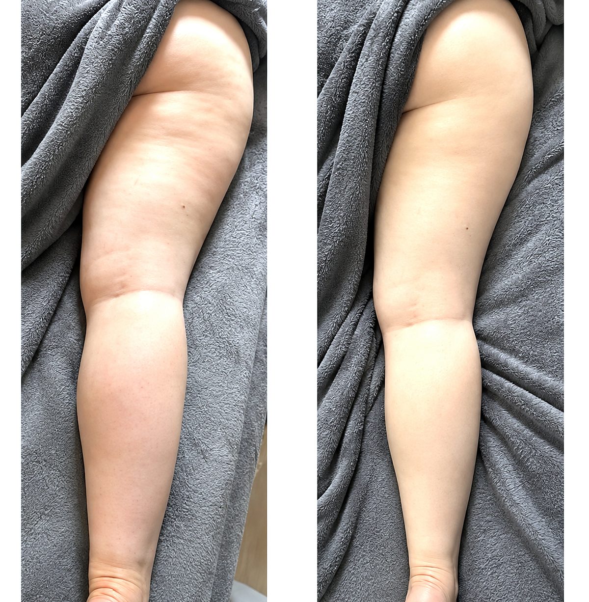 Online-Kurs manuelle Lymphdrainage